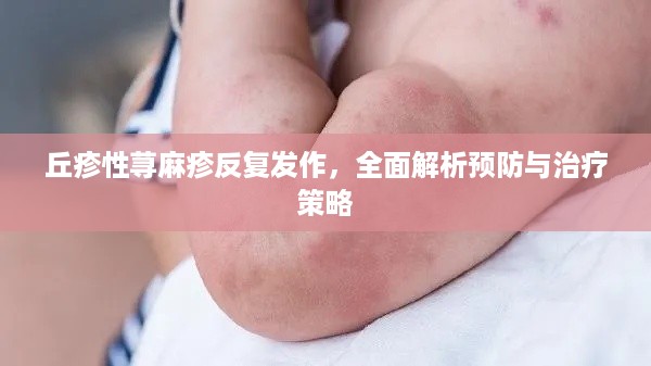 丘疹性荨麻疹反复发作，全面解析预防与治疗策略